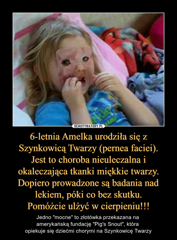 6-letnia Amelka urodziła się z Szynkowicą Twarzy (pernea faciei).Jest to choroba nieuleczalna i okaleczająca tkanki miękkie twarzy. Dopiero prowadzone są badania nad lekiem, póki co bez skutku.Pomóżcie ulżyć w cierpieniu!!! – Jedno "mocne" to złotówka przekazana na amerykańską fundację "Pig's Snout", która opiekuje się dziećmi chorymi na Szynkowicę Twarzy 