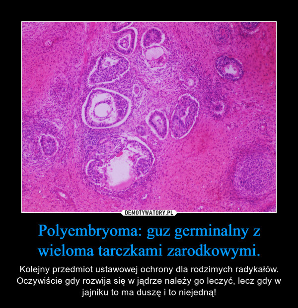 Polyembryoma: guz germinalny z wieloma tarczkami zarodkowymi. – Kolejny przedmiot ustawowej ochrony dla rodzimych radykałów.Oczywiście gdy rozwija się w jądrze należy go leczyć, lecz gdy w jajniku to ma duszę i to niejedną! 