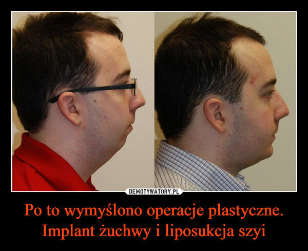 Po to wymyślono operacje plastyczne.
Implant żuchwy i liposukcja szyi